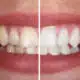 6-surprising-ways-youre-staining-your-teeth
