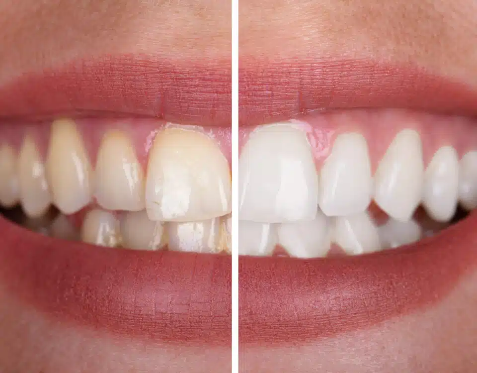 6-surprising-ways-youre-staining-your-teeth