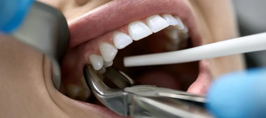 When-Will-Dentists-Pull-Teeth
