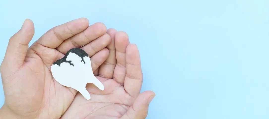 a-step-by-step-guide-to-preventing-tooth-decay