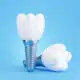 are-dental-implants-a-permanent-solution