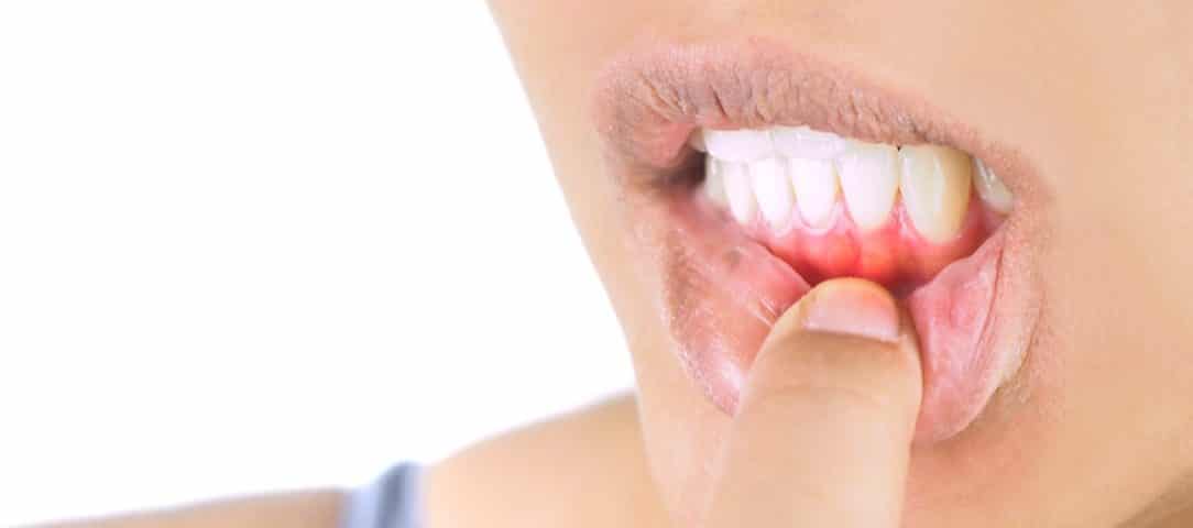 are-you-able-to-reverse-gum-disease