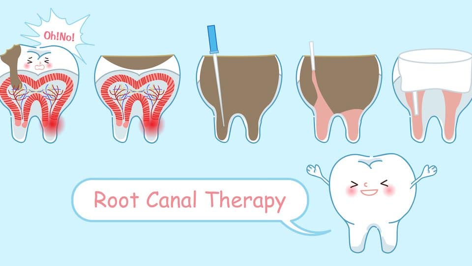 can-a-root-canal-save-your-tooth