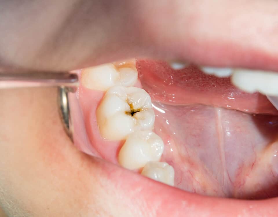 cavities-101