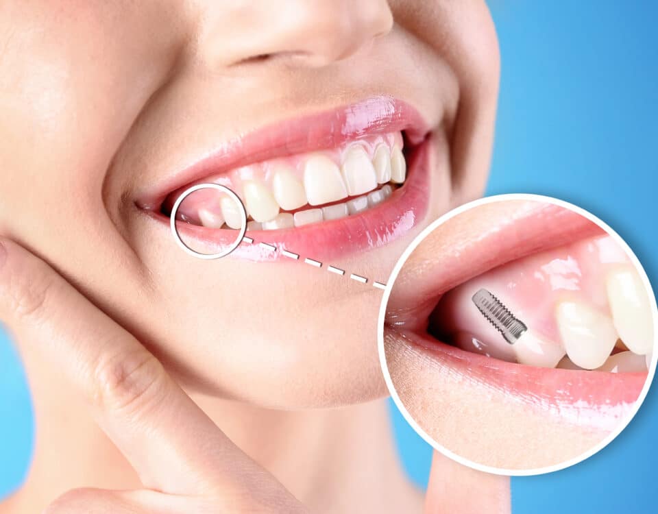 change-your-smile-with-dental-implants