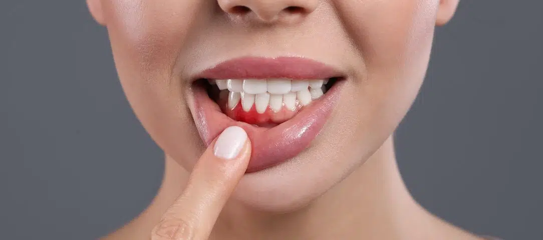 dental-hygiene-month-protect-yourself-against-plaque-and-gingivitis