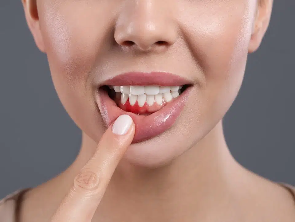 dental-hygiene-month-protect-yourself-against-plaque-and-gingivitis