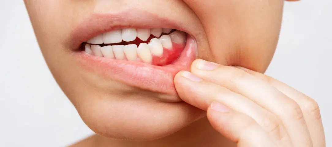 gum-care-aware-what-to-know-for-gum-disease-awareness-month