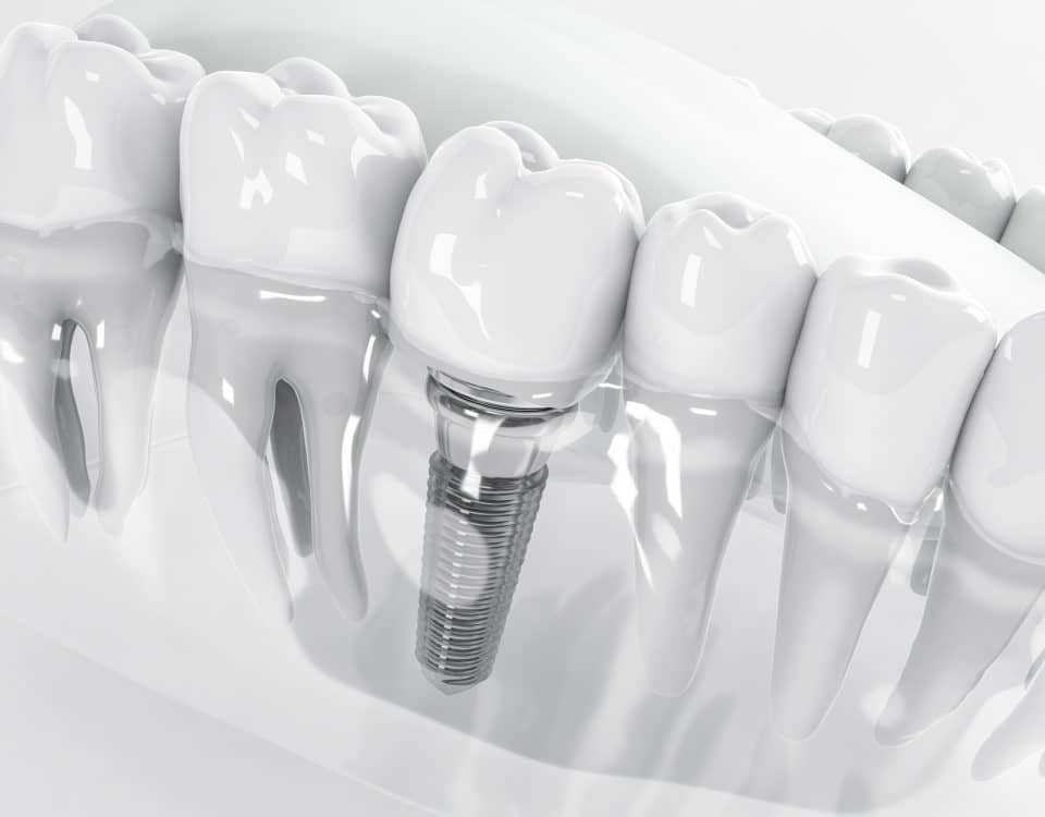 how-dental-implants-can-change-your-smile