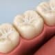 how-dental-sealants-help-protect-teeth-from-cavities