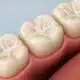 how-dental-sealants-help-protect-teeth-from-cavities