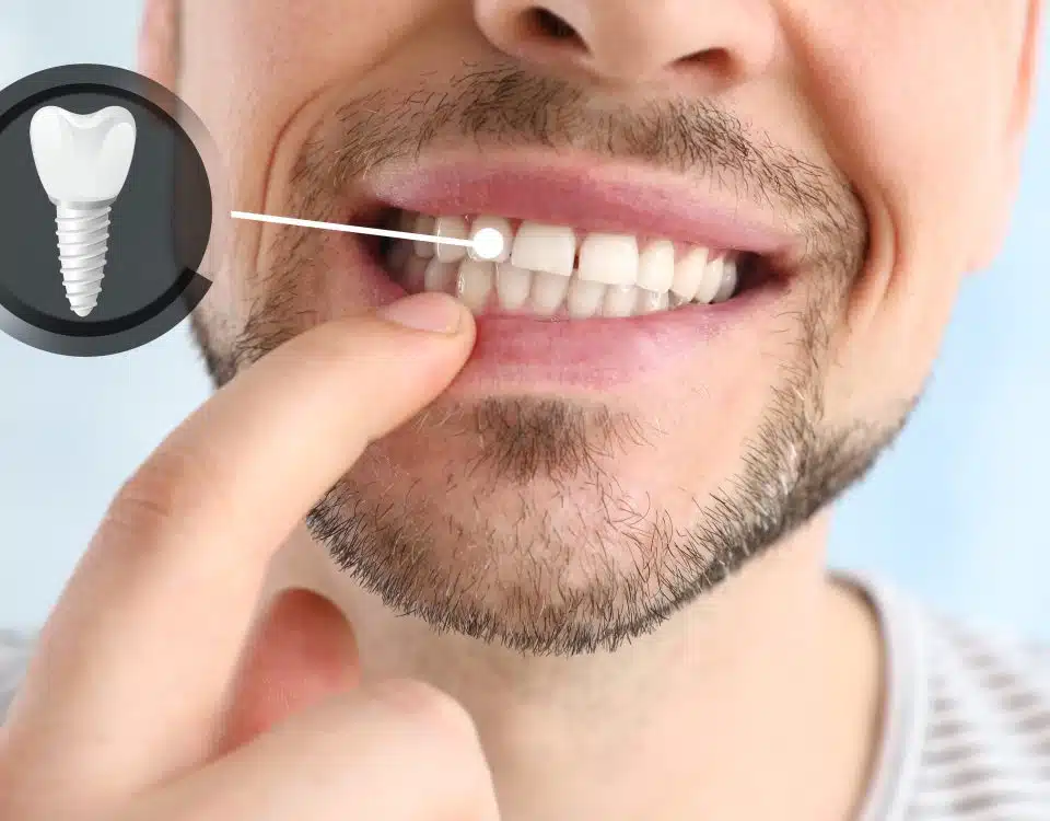 how-long-do-dental-implants-last