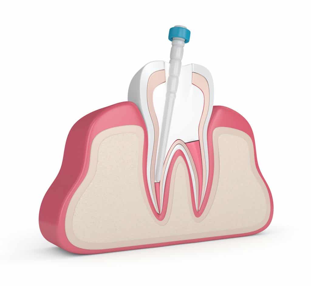 How to Know if a Root Canal is Needed | Stonebrook Family Dental