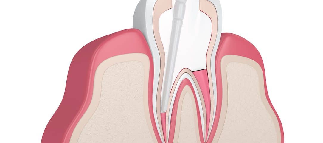 how-to-know-if-a-root-canal-is-needed