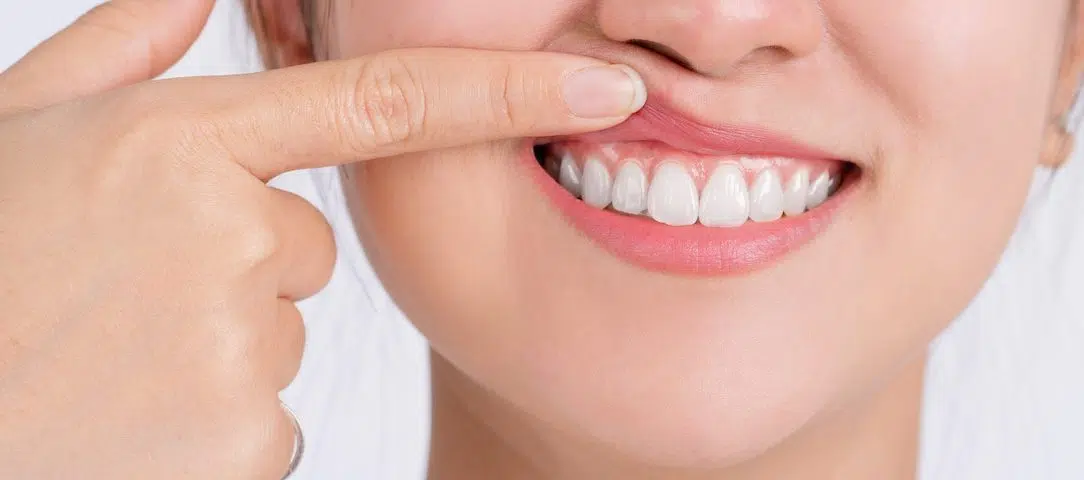 how-to-prevent-and-treat-gum-recession