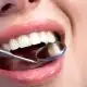 the-benefits-of-composite-fillings