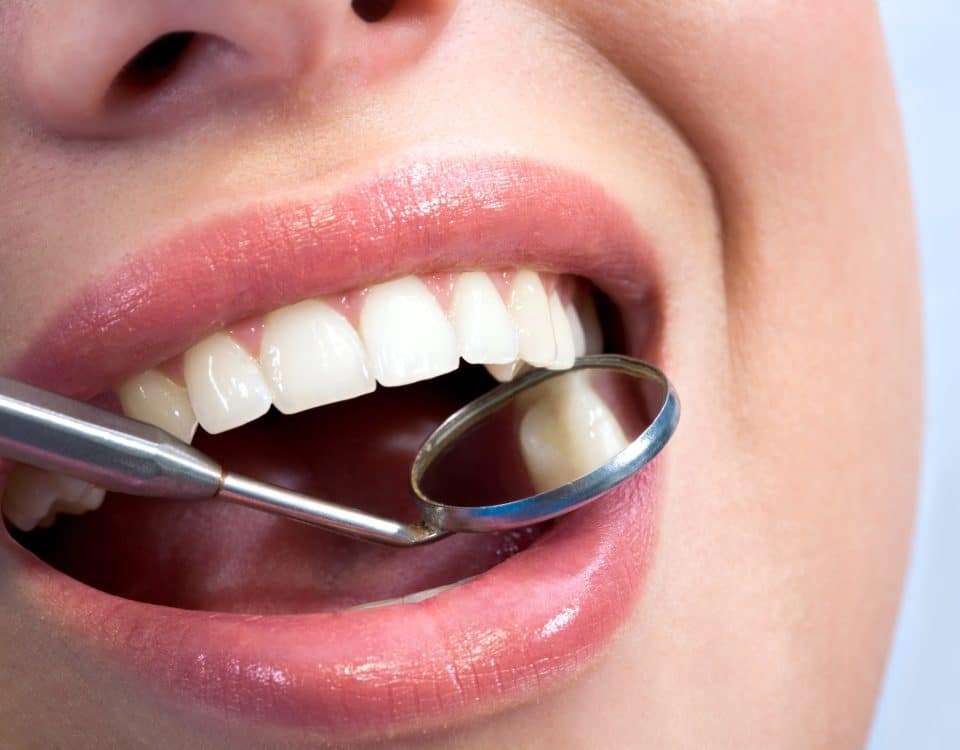 the-benefits-of-composite-fillings