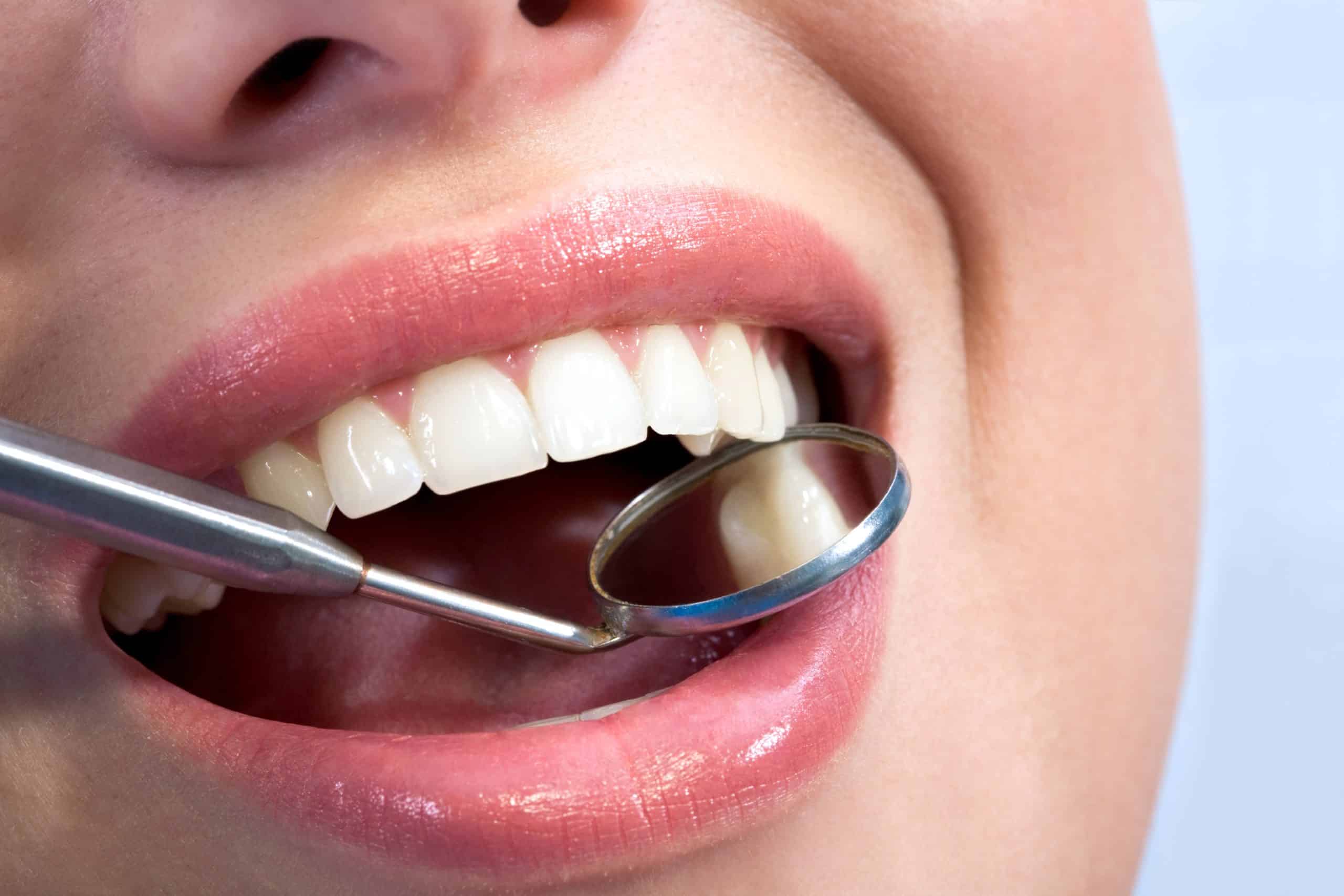 Benefits of Composite Fillings