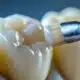 the-benefits-of-dental-sealants-for-adults