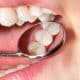the-benefits-of-dental-sealants-for-children-and-adults