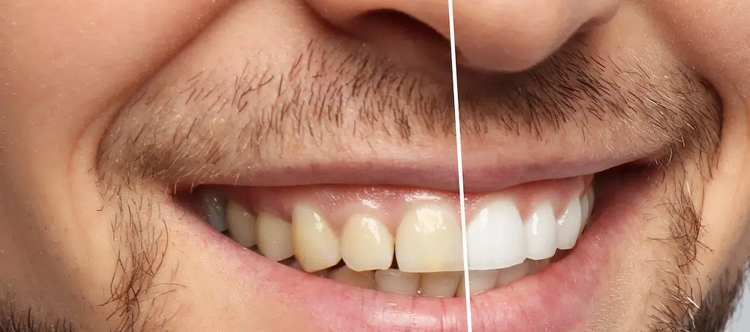 the-cosmetic-dentistry-services-that-can-boost-your-confidence