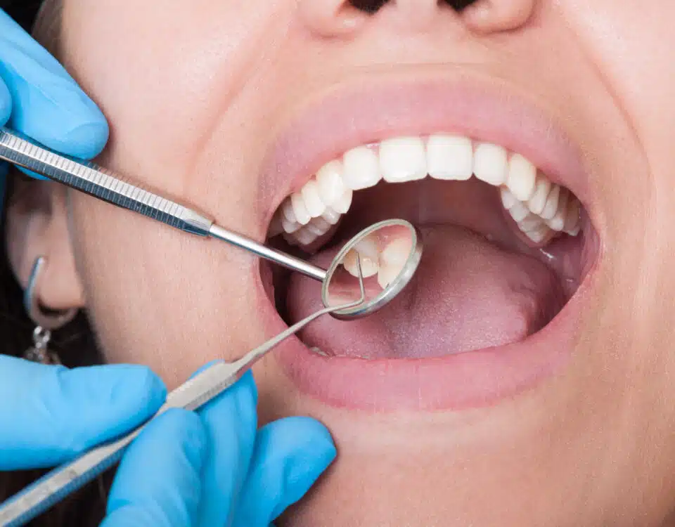 understanding-the-causes-of-cavities-and-how-to-prevent-them