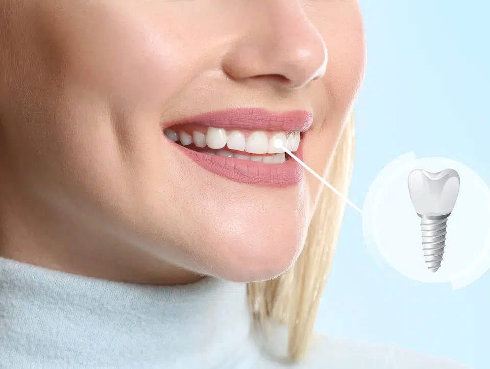 what-to-expect-with-dental-implants