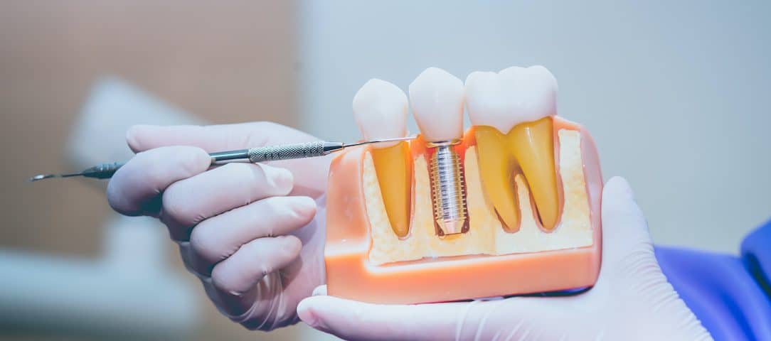 what-you-need-to-know-about-the-benefits-of-dental-implants
