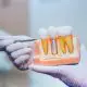 what-you-need-to-know-about-the-benefits-of-dental-implants