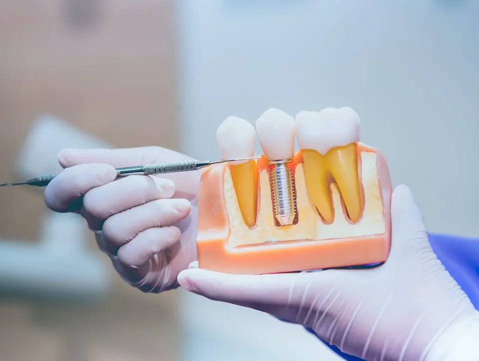 what-you-need-to-know-about-the-benefits-of-dental-implants