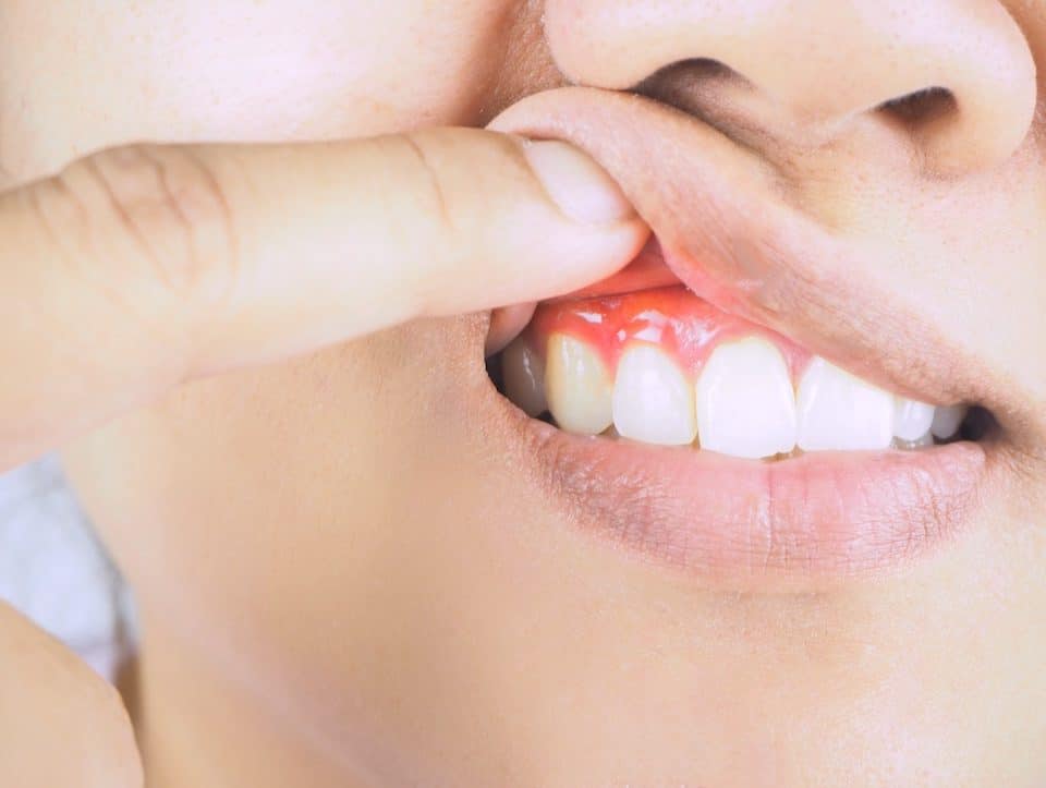 what-your-bleeding-gums-are-trying-to-tell-you